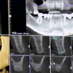 ПОЛЕЗНО ЗНАТЬ: имплантация